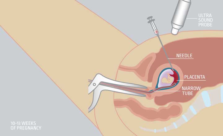 Chorionic villus sampling (CVS)